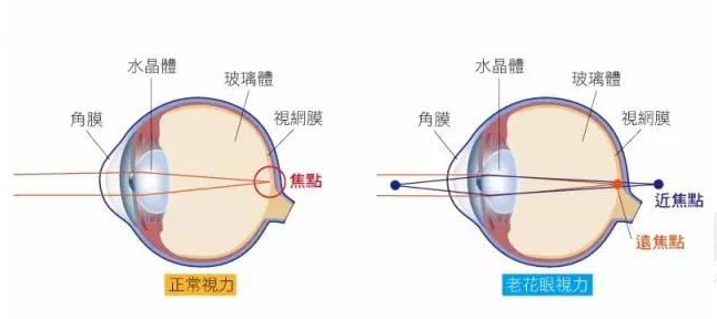 500度近視又老花，戴上美麗島多焦鏡煩惱全解決，46歲的周先生樂壞了